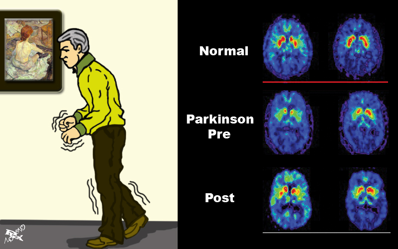 Enfermedad del Parkinson Parkinson
